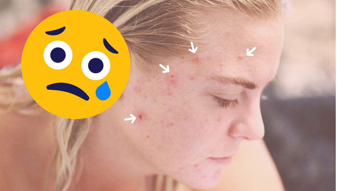 Say Goodbye to Pimples FOREVER: The Ultimate Guide on How to Remove Pimple | Carsha